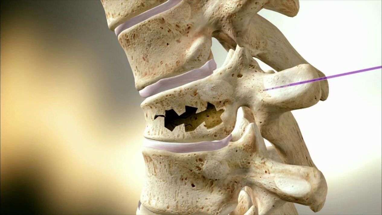 Spinal disc