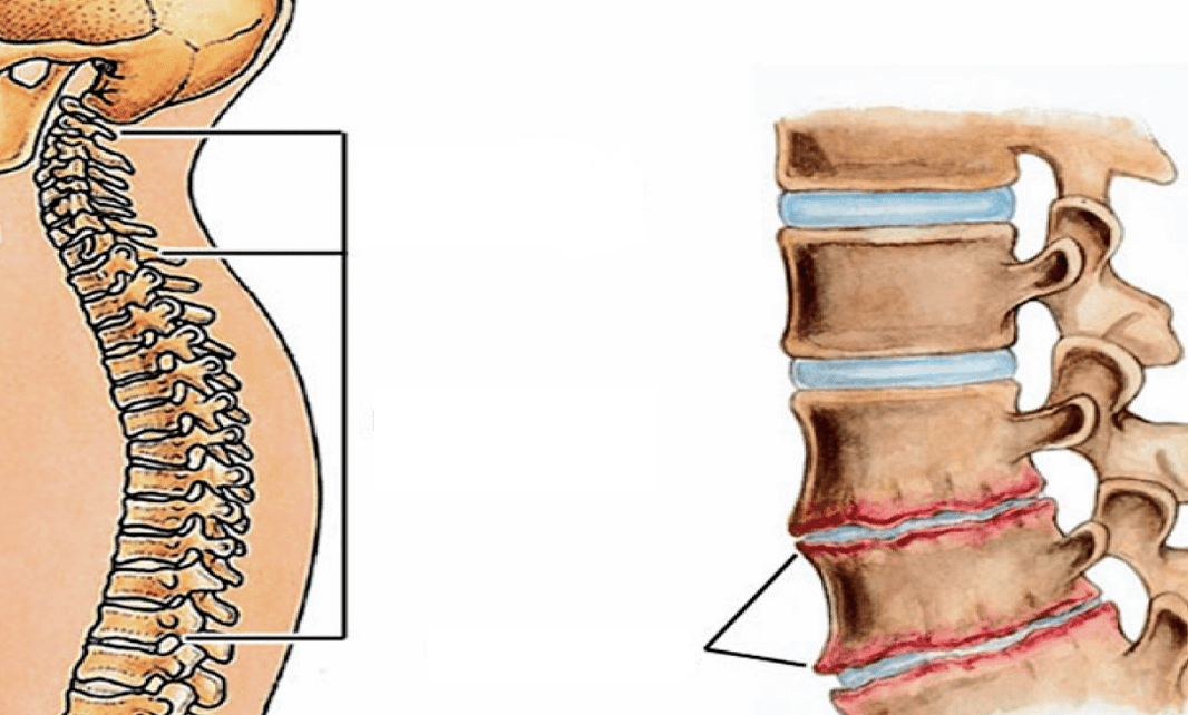 What does osteochondrosis look like in the spine