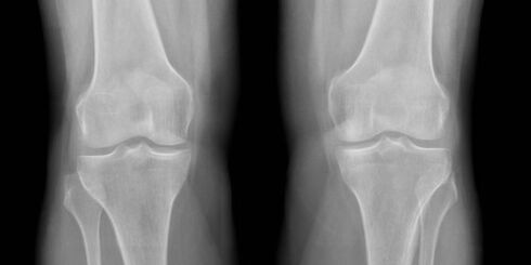 arthrosis of the knee on an X-ray