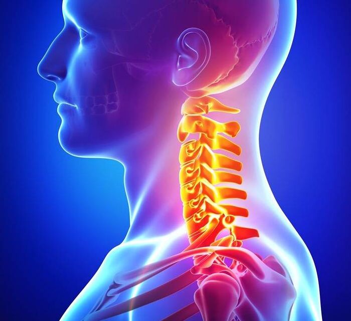 Osteochondrosis of the cervical vertebrae