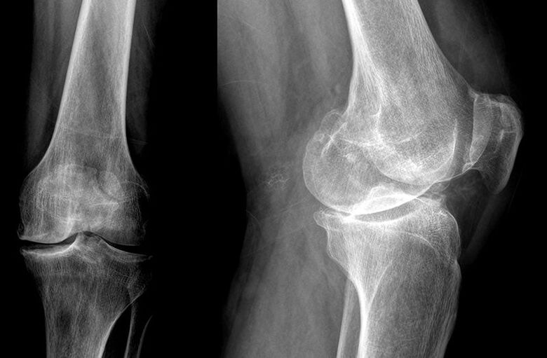 diagnosis of arthrosis of the joints